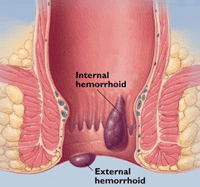 hemorrhoid