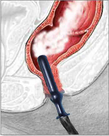 Barium Enema Drawing
