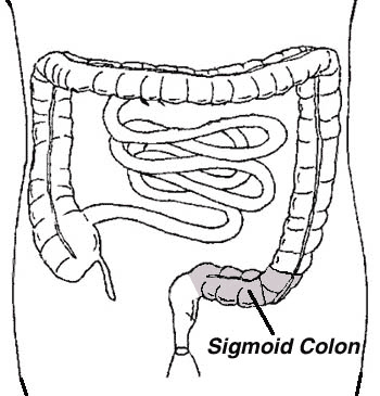 Line Drawing of the Sigmoid Colon
