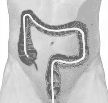 colon_tube_drawing.gif (32867 bytes)