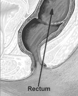 Rectum Picture